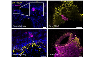癌細(xì)胞會(huì)放電？Nature揭示小細(xì)胞肺癌擴(kuò)散新機(jī)制