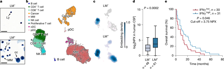  炎癥誘導(dǎo)的腦脊液細胞增多見于軟腦膜轉(zhuǎn)移患者