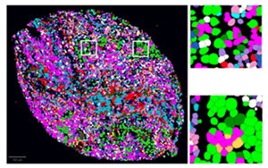 腫瘤微環(huán)境分析發(fā)現(xiàn)肺癌的治療應(yīng)答標志物