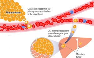 Nature Medicine一項開創(chuàng)性的新研究可防止乳腺癌復發(fā)