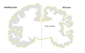 阿爾茨海默病中Tau蛋白病理對腦溝深度的特異性影響及其與海馬功能連接的關聯(lián)研究