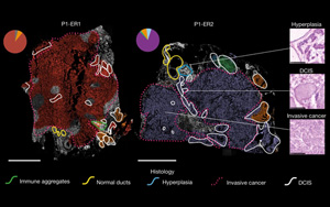 Nature：利用空間基因組學(xué)來了解乳腺癌克隆如何進化