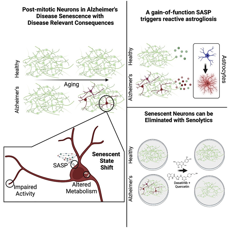 阿爾茨海默病衰老神經(jīng)元有絲分裂后與相應(yīng)的疾病后果 阿爾茨海默病衰老神經(jīng)元有絲分裂后與相應(yīng)的疾病后果