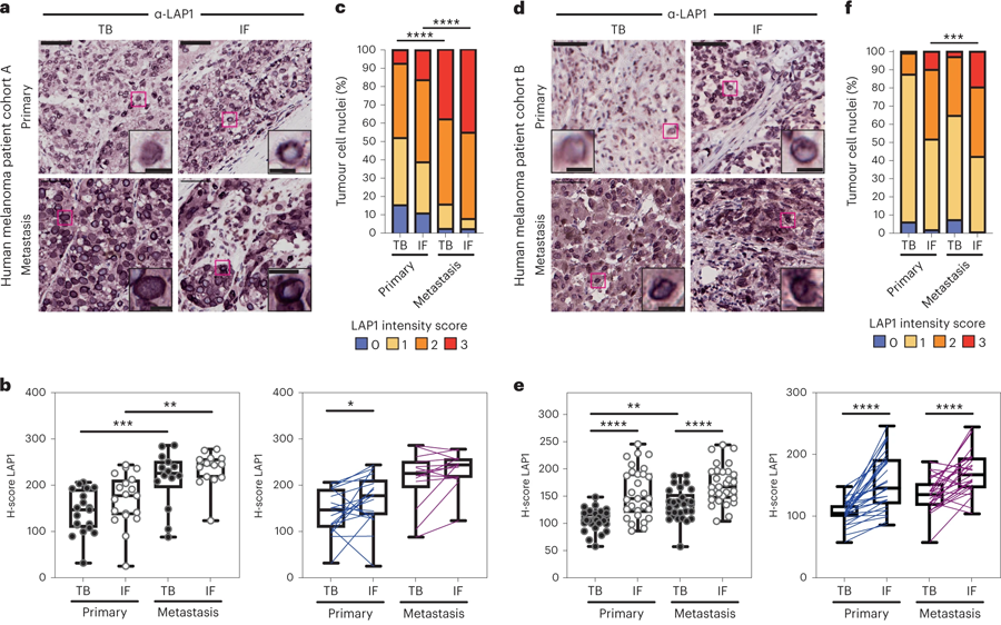 LAP1水平在人類(lèi)黑色素瘤進(jìn)展中增加 LAP1水平在人類(lèi)黑色素瘤進(jìn)展中增加