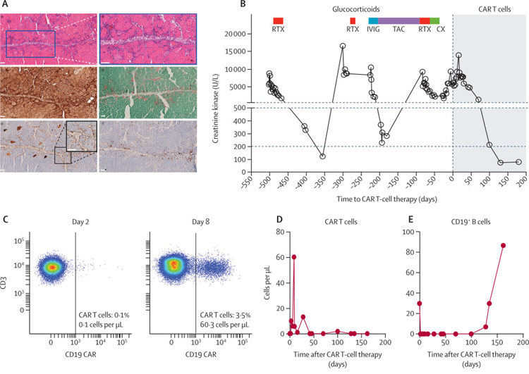 CAR T細(xì)胞對(duì)抗突觸綜合征表現(xiàn)的影響