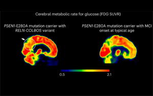 Nature Medicine發(fā)現(xiàn)了新的基因變異，可以預(yù)防阿爾茨海默病