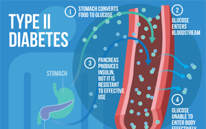 Nature Medicine：2型糖尿病的多祖先多基因機(jī)制